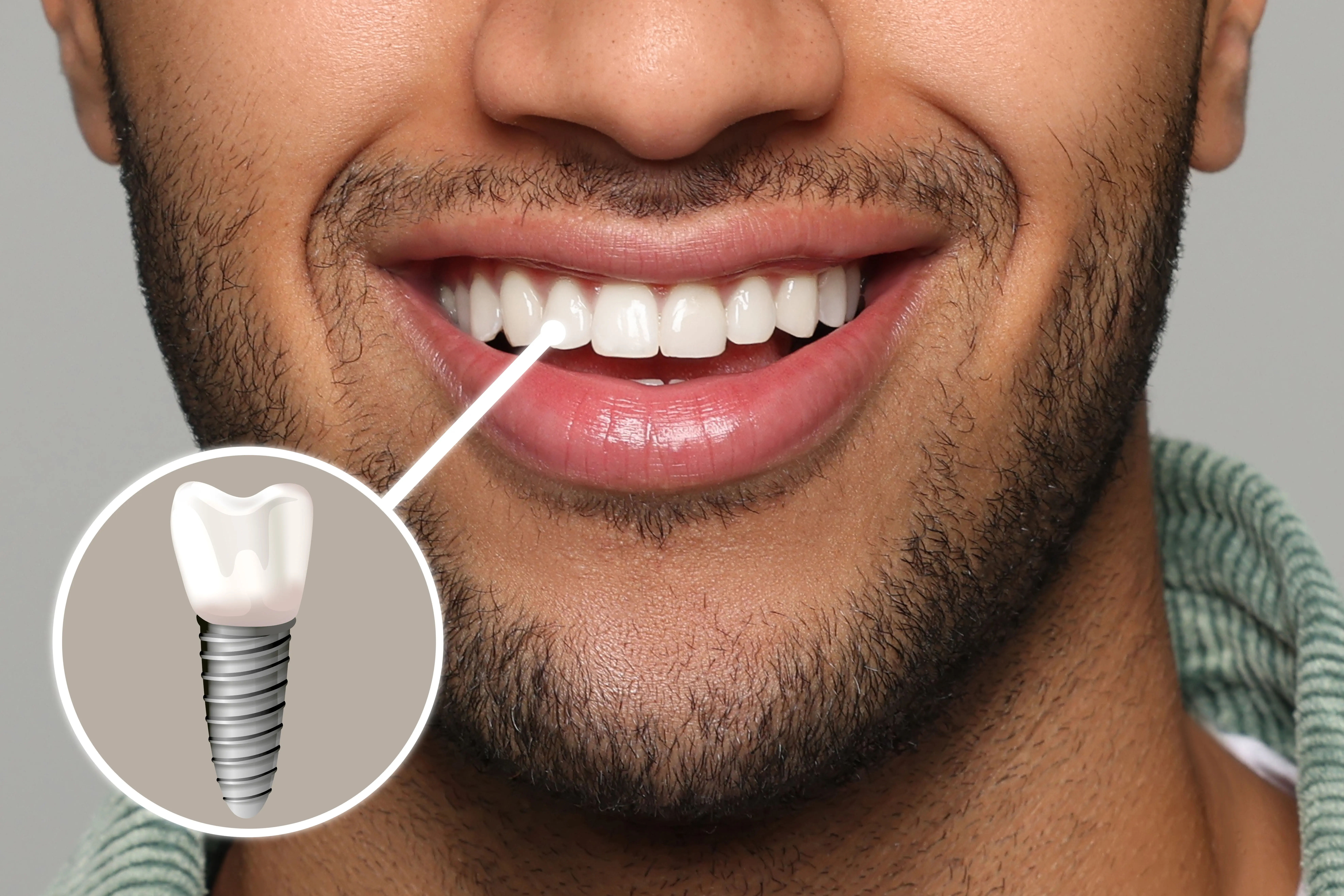 Guide to Dental Implants Get Your Fixed Teeth Back in No Time
